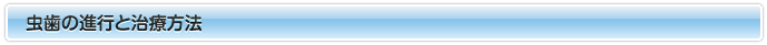 虫歯の進行と治療方法