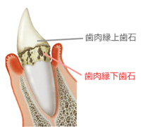 歯石